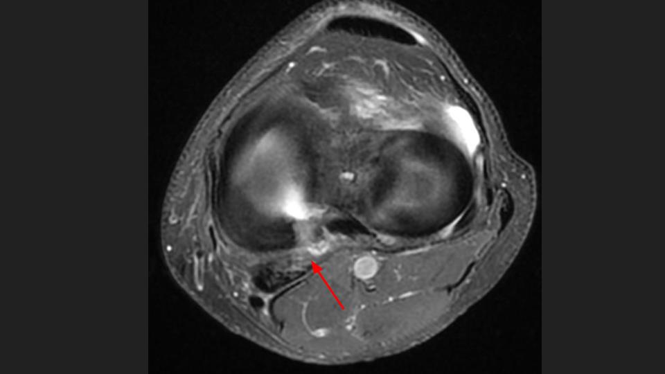 Figure 5 for case posterior horn of medial meniscus ( RID2776 )